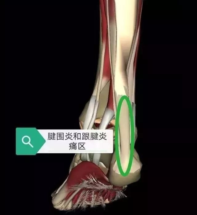 脚腱鞘炎位置图图片
