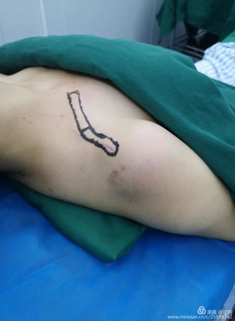 Illustration 2 for 锁骨骨折怕留疤？MIPO微创技术给你MIPO新选择！MIPO专家解析：解锁快速美观愈合秘诀