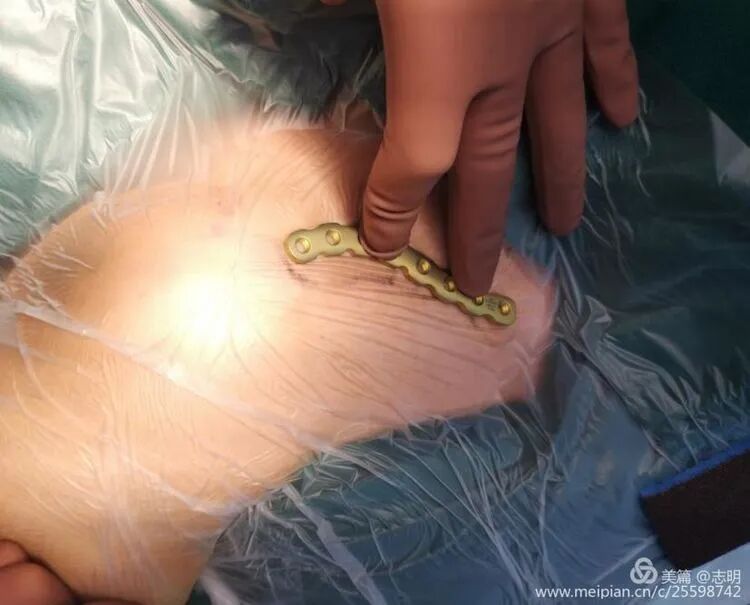 Illustration 4 for 锁骨骨折怕留疤？MIPO微创技术给你MIPO新选择！MIPO专家解析：解锁快速美观愈合秘诀