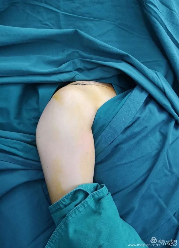 Illustration 3 for 锁骨骨折怕留疤?MIPO微创技术给你MIPO新选择!MIPO专家解析:解锁快速美观愈合秘诀