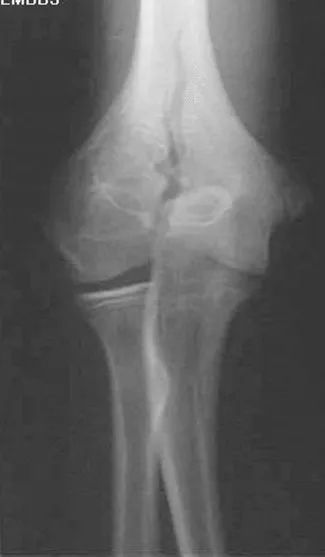 疼痛科怎么理疗疼痛科医生、康复理疗科医生、针刀针灸医生应掌握的常见骨科疾病X光片_https://www.jmylbn.com_新闻资讯_第14张