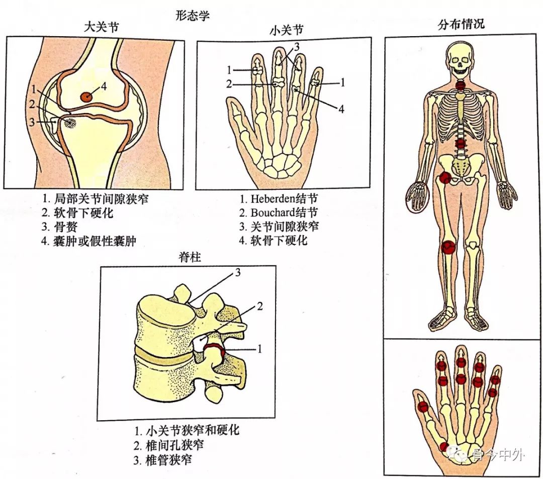 读片技巧 3大类退行性关节疾病 骨今中外 微信公众号文章阅读 Wemp