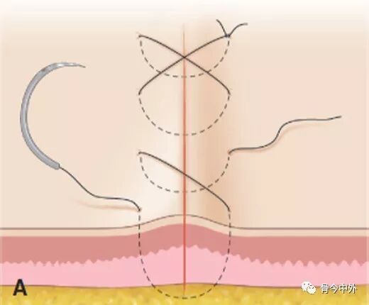 缝合针怎么选规格外科手术“3大缝合工具+7种缝合方式”，超级实用！_https://www.jmylbn.com_新闻资讯_第7张
