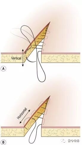缝合针怎么选规格外科手术“3大缝合工具+7种缝合方式”，超级实用！_https://www.jmylbn.com_新闻资讯_第6张