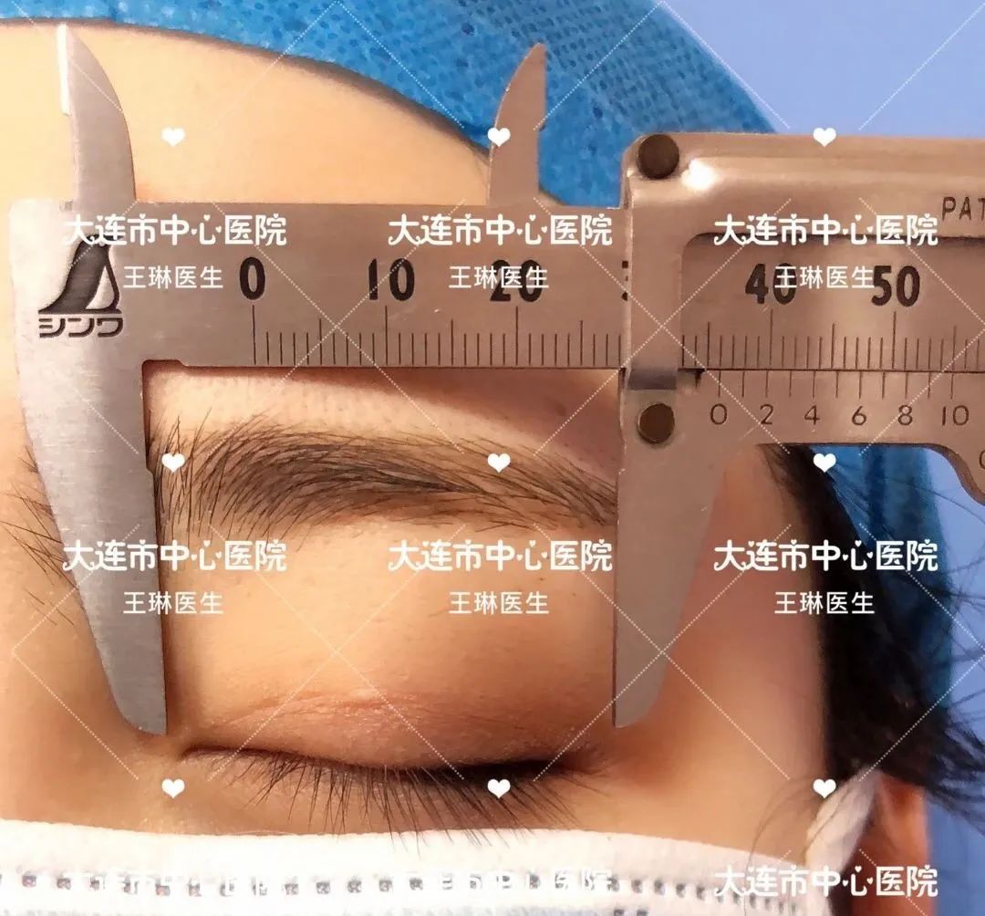 双眼皮手术深圳哪家医院效果好_深圳双眼皮手术_深圳哪家做双眼皮手术好