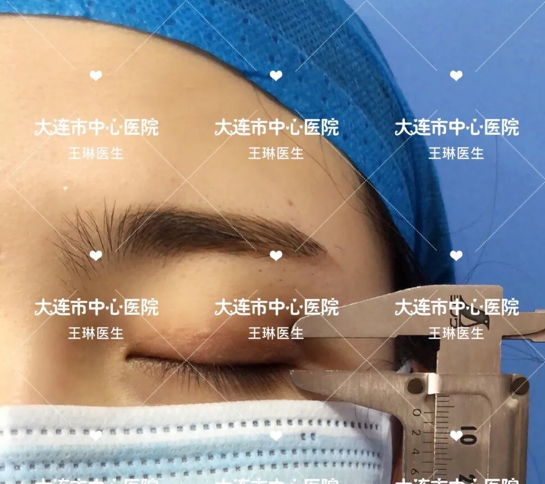 深圳哪家做双眼皮手术好_双眼皮手术深圳哪家医院效果好_深圳双眼皮手术