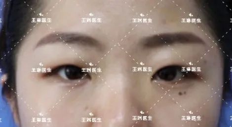 深圳双眼皮手术_双眼皮手术深圳哪家医院效果好_深圳哪家做双眼皮手术好
