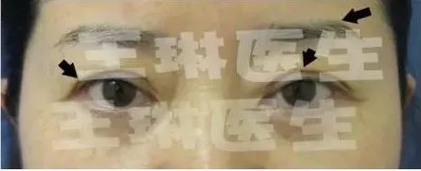 双眼皮手术深圳哪家医院效果好_深圳双眼皮手术_深圳哪家做双眼皮手术好