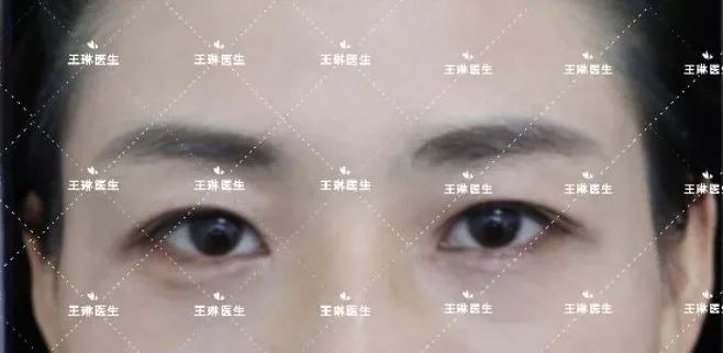 深圳双眼皮手术_深圳哪家做双眼皮手术好_双眼皮手术深圳哪家医院效果好