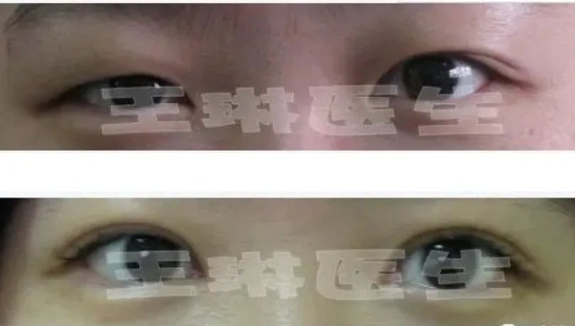 深圳哪家做双眼皮手术好_双眼皮手术深圳哪家医院效果好_深圳双眼皮手术