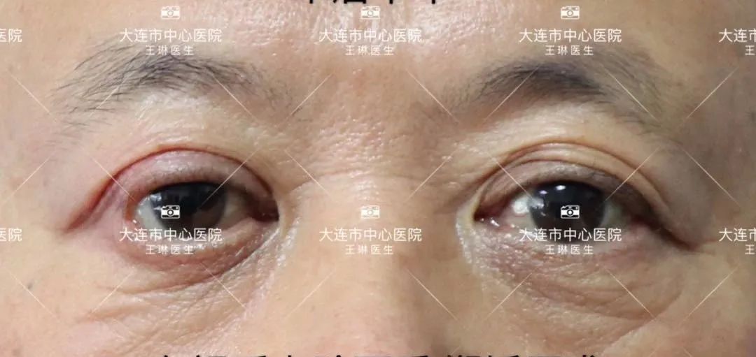 深圳双眼皮手术_深圳哪家做双眼皮手术好_双眼皮手术深圳哪家医院效果好