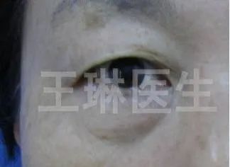 双眼皮手术深圳哪家医院效果好_深圳双眼皮手术_深圳哪家做双眼皮手术好