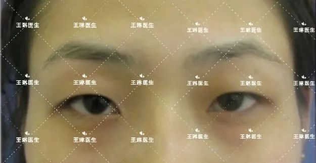 深圳哪家做双眼皮手术好_深圳双眼皮手术_双眼皮手术深圳哪家医院效果好