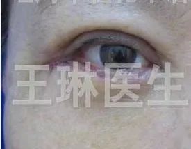 深圳哪家做双眼皮手术好_双眼皮手术深圳哪家医院效果好_深圳双眼皮手术