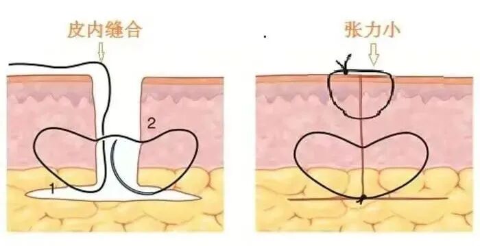 可吸收缝线怎么拆可吸收缝线与不可吸收缝线的区别！_https://www.jmylbn.com_新闻资讯_第1张