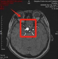 联磁共振是什么【内分泌糖尿病医院】AI查体联合磁共振“抓出”颅内动脉瘤_https://www.jmylbn.com_新闻资讯_第1张