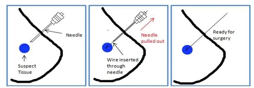 为什么要定位针 乳腺方医生专栏 ｜ 手术前的病灶定位，要在我的胸上插根针？！超声引导下乳腺金属定位导丝置入术究竟是怎么做的？_https://www.jmylbn.com_新闻资讯_第11张