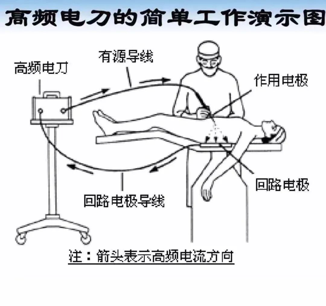 高频刀是什么高频电刀，超声刀，LigaSure血管闭合系统的区别和对比_https://www.jmylbn.com_新闻资讯_第2张