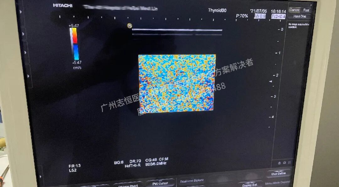 日立图腾怎么样超声案例：日立图腾血流模式报错_https://www.jmylbn.com_新闻资讯_第17张