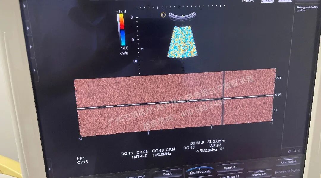 日立图腾怎么样超声案例：日立图腾血流模式报错_https://www.jmylbn.com_新闻资讯_第18张