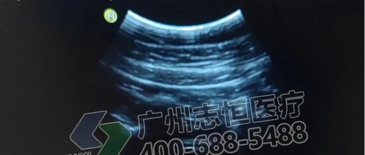 日立图腾怎么样超声案例：日立图腾血流模式报错_https://www.jmylbn.com_新闻资讯_第21张