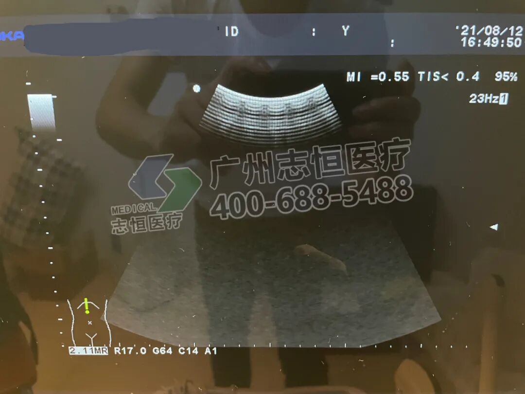 aloka超声怎么样超声维修：ALOKA α6 图像亮道故障_https://www.jmylbn.com_新闻资讯_第4张