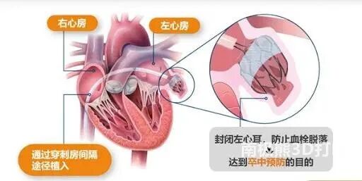 全彩3D打印助力心臟介入最有挑戰性的術式之左心耳封堵術的圖2