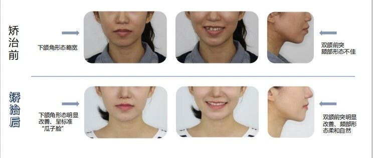 义齿金属3D打印大厂瑞通生物，今年收入将超1亿，合作义齿厂已超300家