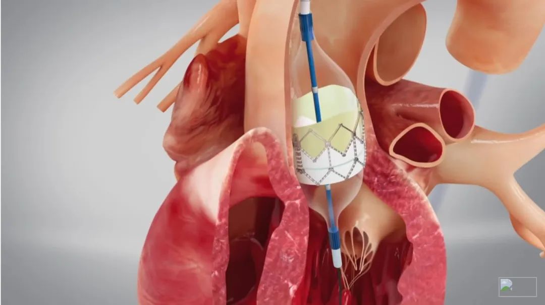 哈佛大学3D打印合成心脏瓣膜，可伴随儿童一起生长，减少手术次数的图10