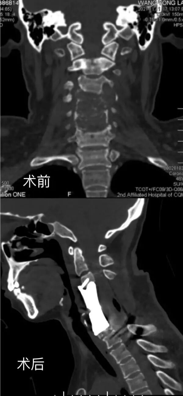 重医二院挑战“生命禁区” 3D打印让恶性颈椎肿瘤患者获新生的图3