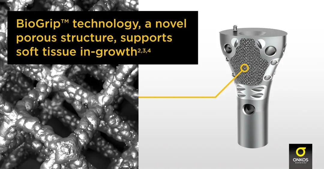 3D打印骨盆获得FDA批准，Onkos Surgical 已允许用于临床重建治疗的图3