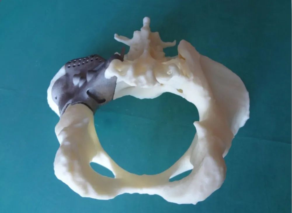3D打印骨盆获得FDA批准，Onkos Surgical 已允许用于临床重建治疗的图1