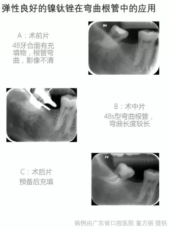 使用镍钛根管锉，如何避免断针？