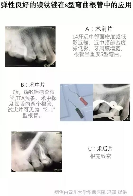 使用镍钛根管锉，如何避免断针？