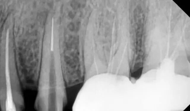 使用镍钛根管锉，如何避免断针？