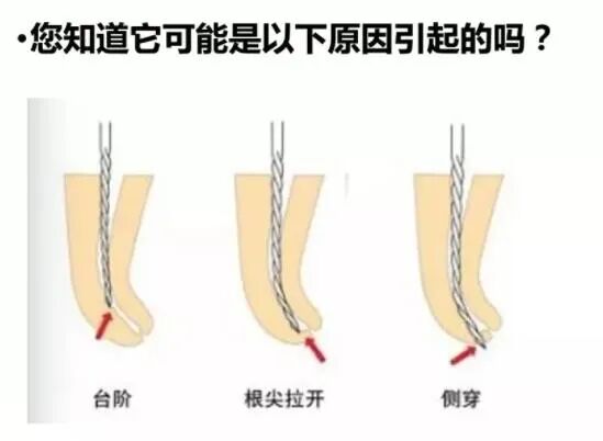 使用镍钛根管锉，如何避免断针？