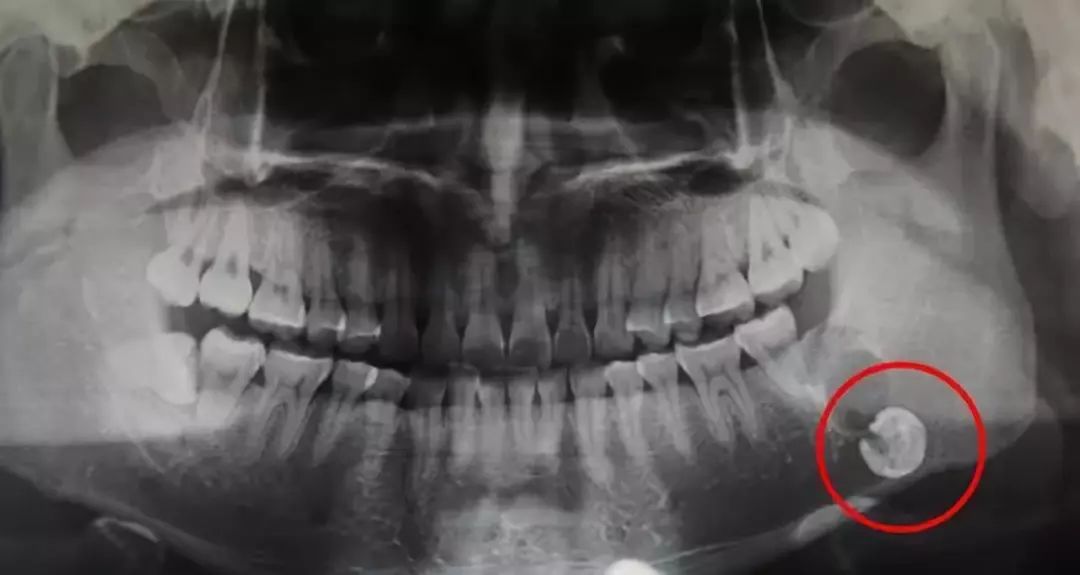 “牙齿躲猫猫？”4个小时都拔不出的智齿长啥样？