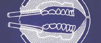 牙科材料硅胶怎么用软衬材料的应用及操作案例_https://www.jmylbn.com_新闻资讯_第2张