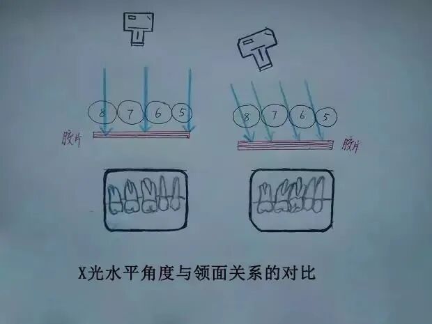 x光机为什么X光机的拍摄技术与心得，牙医和护士都要懂！_https://www.jmylbn.com_新闻资讯_第12张