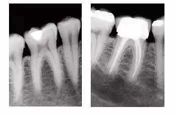 x光机为什么X光机的拍摄技术与心得，牙医和护士都要懂！_https://www.jmylbn.com_新闻资讯_第6张