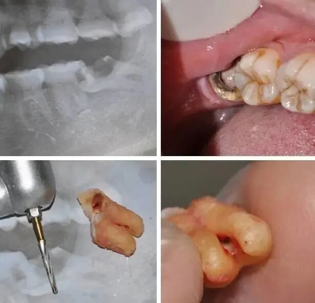拔智齿前的阻力评估，本文适合年轻牙医