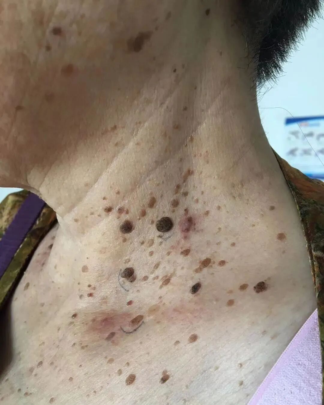 什么是牵引床什么是老年疣，如何治疗？_https://www.jmylbn.com_新闻资讯_第3张