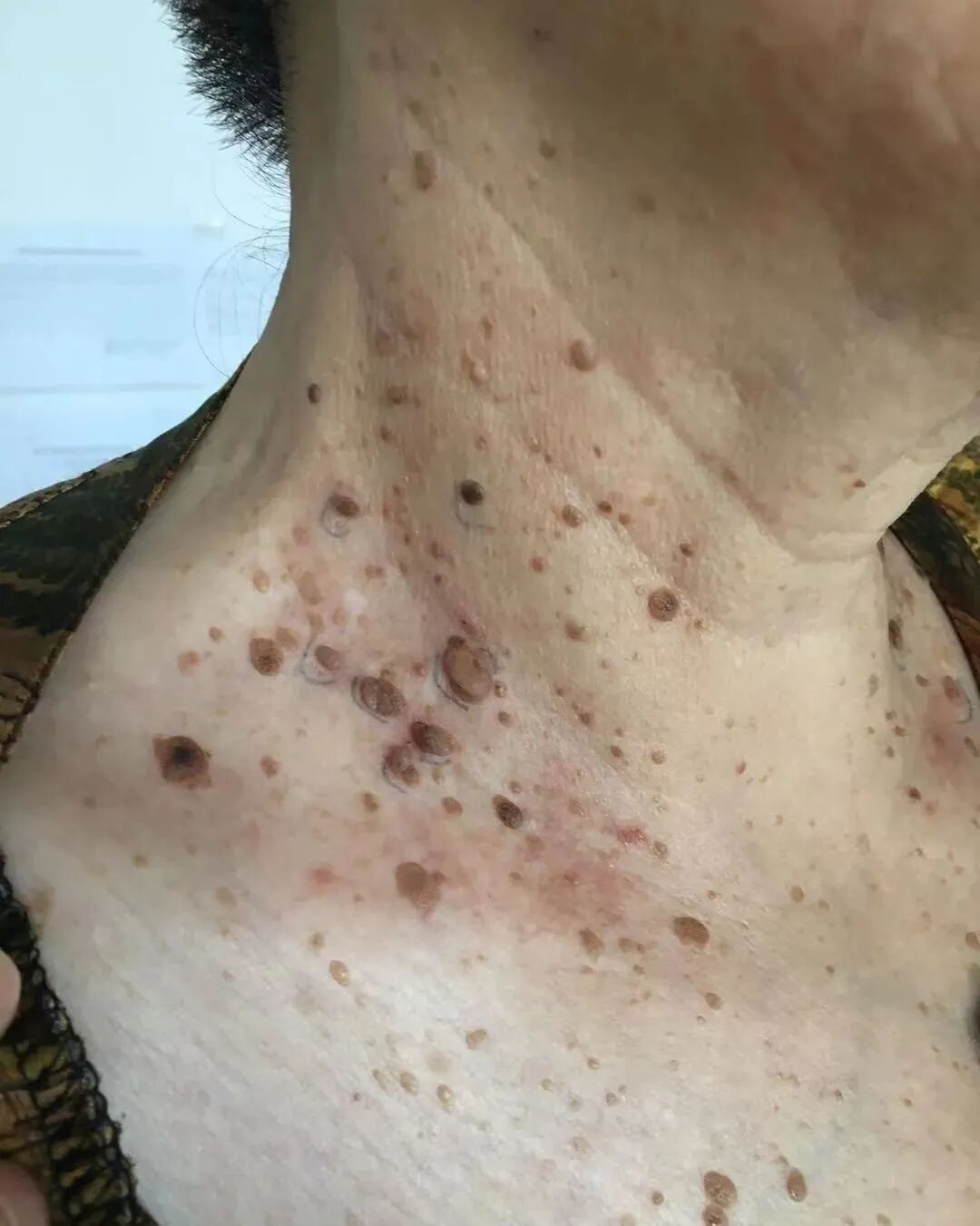 什么是牵引床什么是老年疣，如何治疗？_https://www.jmylbn.com_新闻资讯_第4张