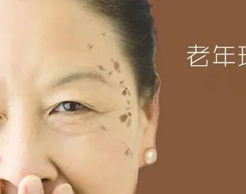 什么是牵引床什么是老年疣，如何治疗？_https://www.jmylbn.com_新闻资讯_第2张