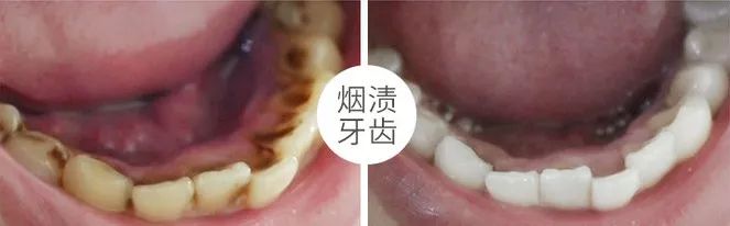 黃牙、口臭、煙牙有救了！用它漱口，乾淨！ 健康 第15張