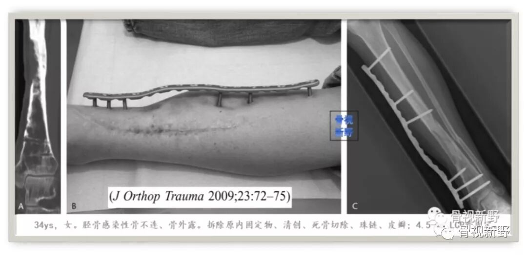 锁定钢板的外固定应用