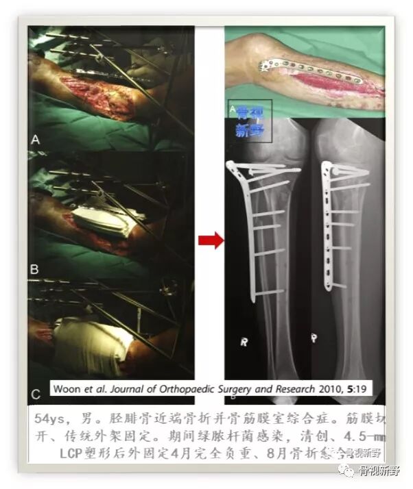 锁定钢板的外固定应用
