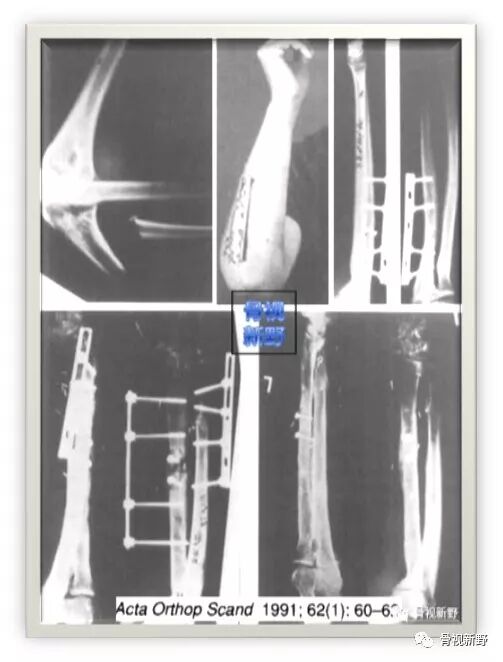 锁定钢板的外固定应用