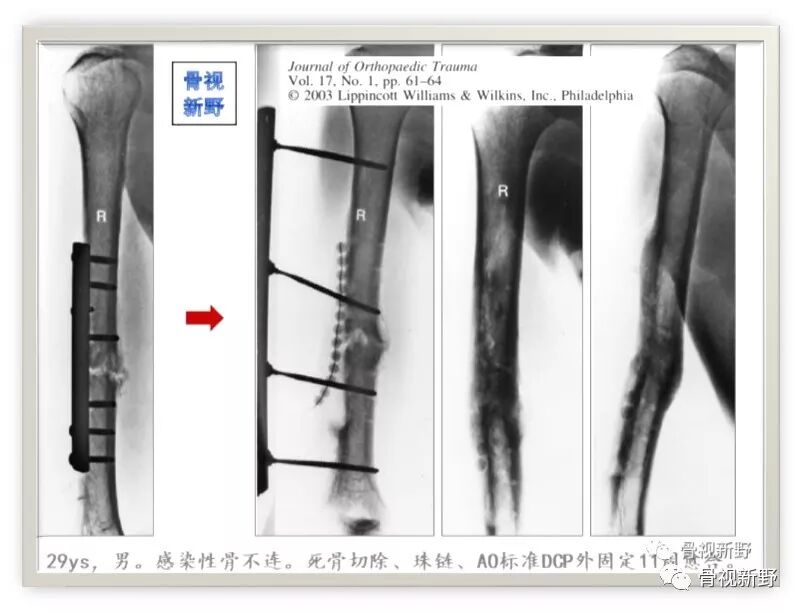 锁定钢板的外固定应用