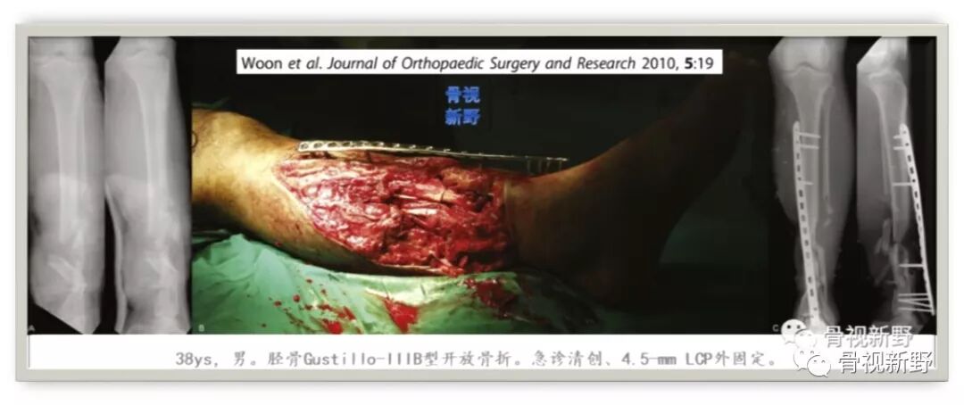 锁定钢板的外固定应用